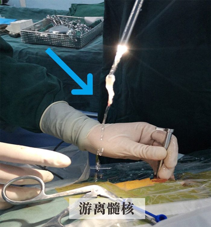 游离髓核.jpg 游离髓核.jpg