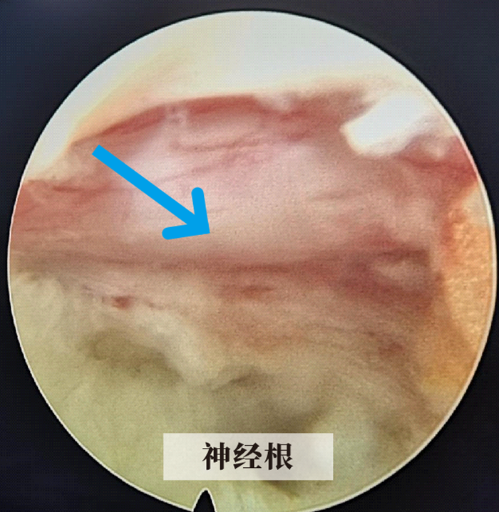神经根.png 神经根.png